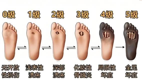 生物活性多糖促进糖尿病足愈合与修复的原理